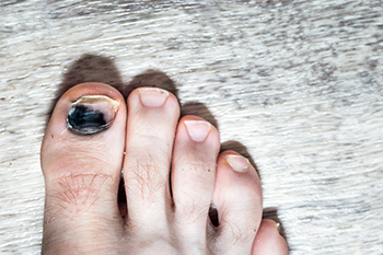 Toenail Issues Common to Runners - Blog