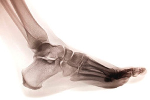 Dealing with Stress Fractures of the Foot and Ankle