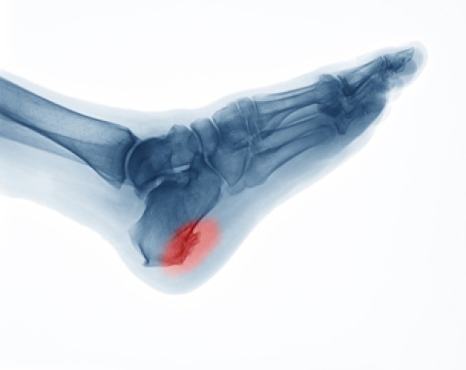 How to Treat Heel Spurs