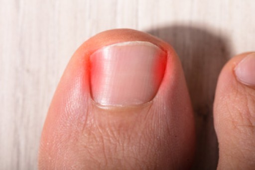 Identifying the Symptoms and Causes of an Ingrown Toenail