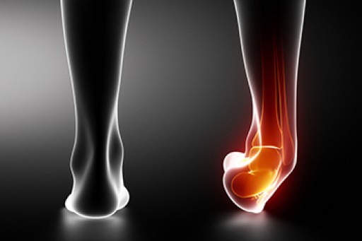 Ankle Sprains