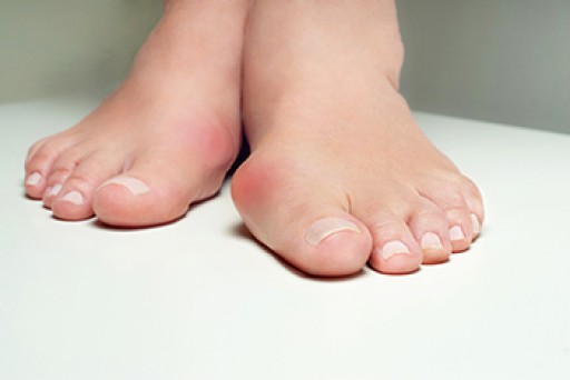 Bunion Symptoms and Treatment