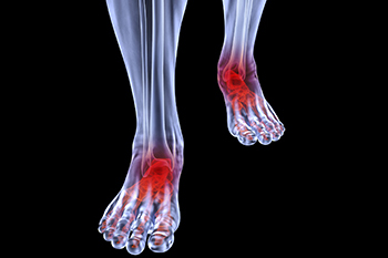 arthritic foot and ankle care treatment in the Nassau County, NY: Long Beach (Freeport, Oceanside, Rockville Centre, Merrick, Lynbrook, Woodmere, Bellmore, Roslyn) and Williston Park (Hempstead, Levittown, Elmont, Uniondale, Garden City, Mineola) areas