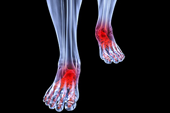 arthritic foot and ankle care treatment in the Nassau County, NY: Long Beach (Freeport, Oceanside, Rockville Centre, Merrick, Lynbrook, Woodmere, Bellmore, Roslyn) and Williston Park (Hempstead, Levittown, Elmont, Uniondale, Garden City, Mineola) areas