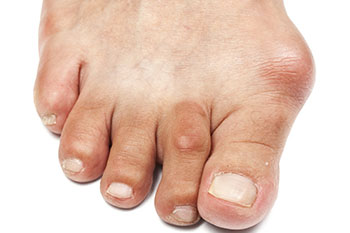 bunions treatment in the Nassau County, NY: Long Beach (Freeport, Oceanside, Rockville Centre, Merrick, Lynbrook, Woodmere, Bellmore, Roslyn) and Williston Park (Hempstead, Levittown, Elmont, Uniondale, Garden City, Mineola) areas