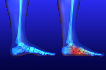 Flat feet and Fallen Arches treatment in in the Nassau County, NY: Long Beach (Freeport, Oceanside, Rockville Centre, Merrick, Lynbrook, Woodmere, Bellmore, Roslyn) and Williston Park (Hempstead, Levittown, Elmont, Uniondale, Garden City, Mineola) areas