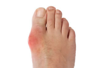 gout treatment in the Nassau County, NY: Long Beach (Freeport, Oceanside, Rockville Centre, Merrick, Lynbrook, Woodmere, Bellmore, Roslyn) and Williston Park (Hempstead, Levittown, Elmont, Uniondale, Garden City, Mineola) areas