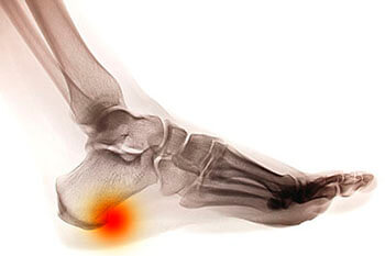 Heel spurs treatment in the Nassau County, NY: Long Beach (Freeport, Oceanside, Rockville Centre, Merrick, Lynbrook, Woodmere, Bellmore, Roslyn) and Williston Park (Hempstead, Levittown, Elmont, Uniondale, Garden City, Mineola) areas