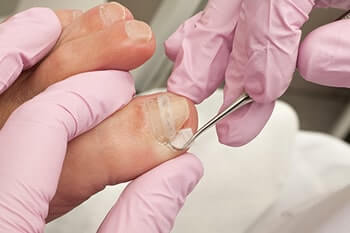 Ingrown toenails treatment in the Nassau County, NY: Long Beach (Freeport, Oceanside, Rockville Centre, Merrick, Lynbrook, Woodmere, Bellmore, Roslyn) and Williston Park (Hempstead, Levittown, Elmont, Uniondale, Garden City, Mineola) areas