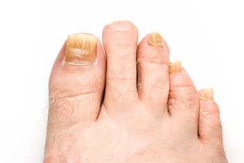 Toenail Fungus Laser Treatment in the Nassau County, NY: Long Beach (Freeport, Oceanside, Rockville Centre, Merrick, Lynbrook, Woodmere, Bellmore, Roslyn) and Williston Park (Hempstead, Levittown, Elmont, Uniondale, Garden City, Mineola) areas